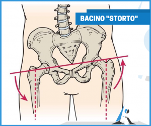 Postura storta: il bacino storto