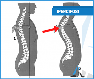 Ipercifosi
